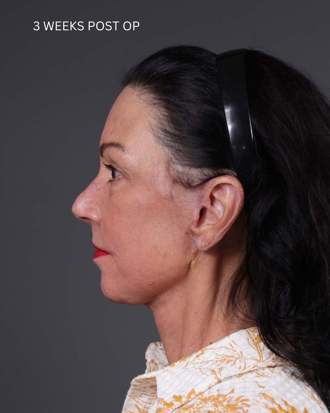Facelift Before & After Gallery - Patient 199753 - Image 18