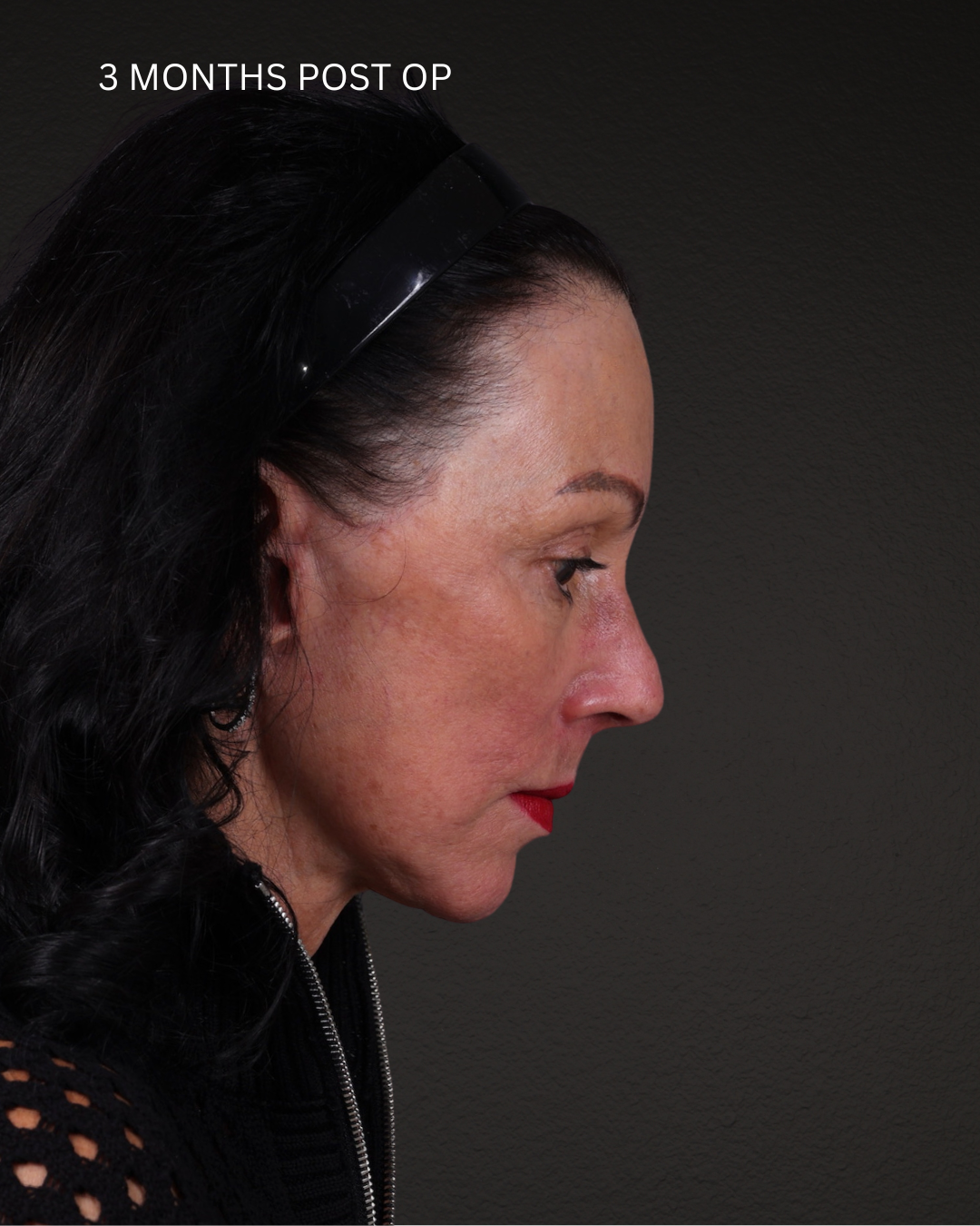 Facelift Before & After Gallery - Patient 199753 - Image 6