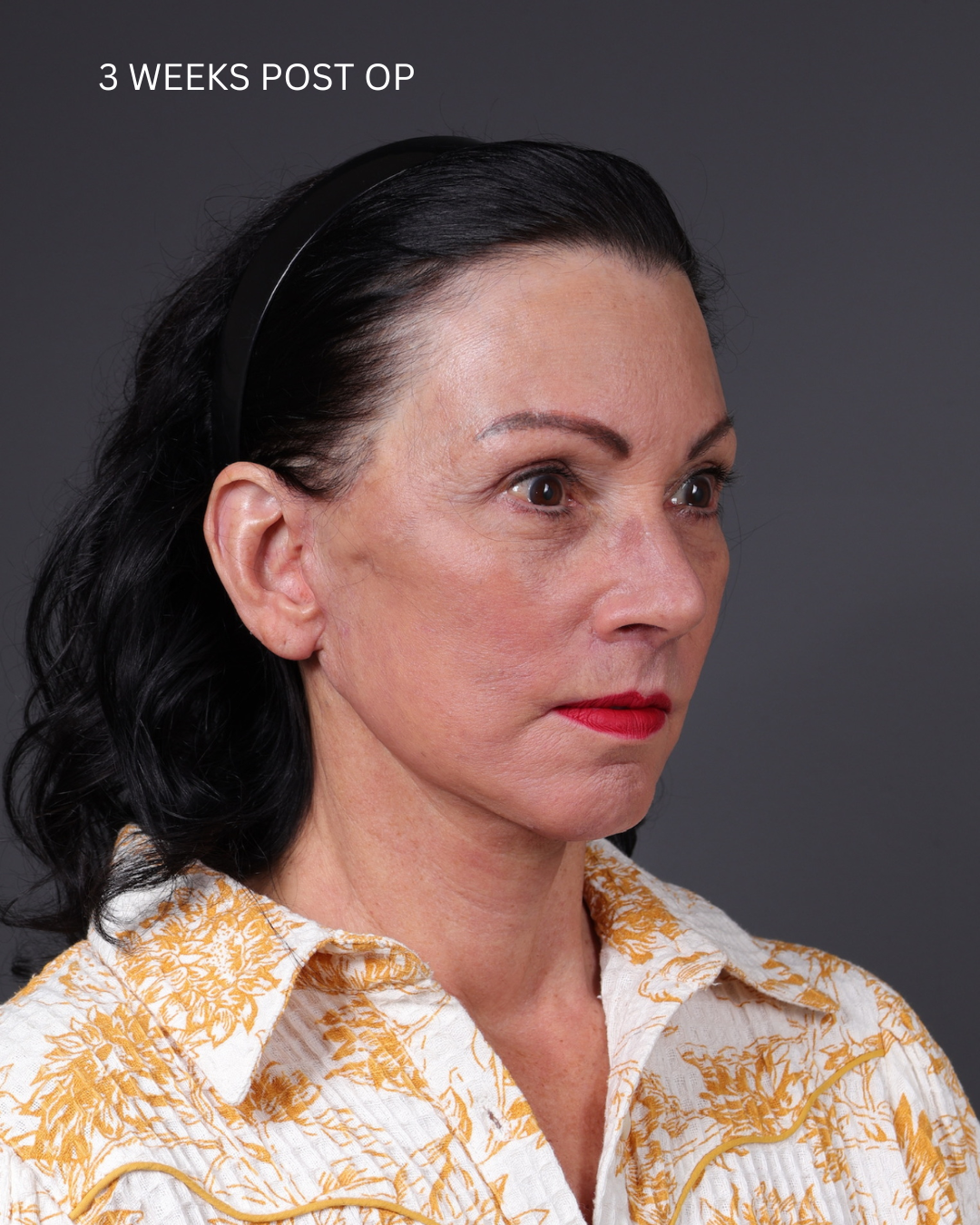 Facelift Before & After Gallery - Patient 199753 - Image 12