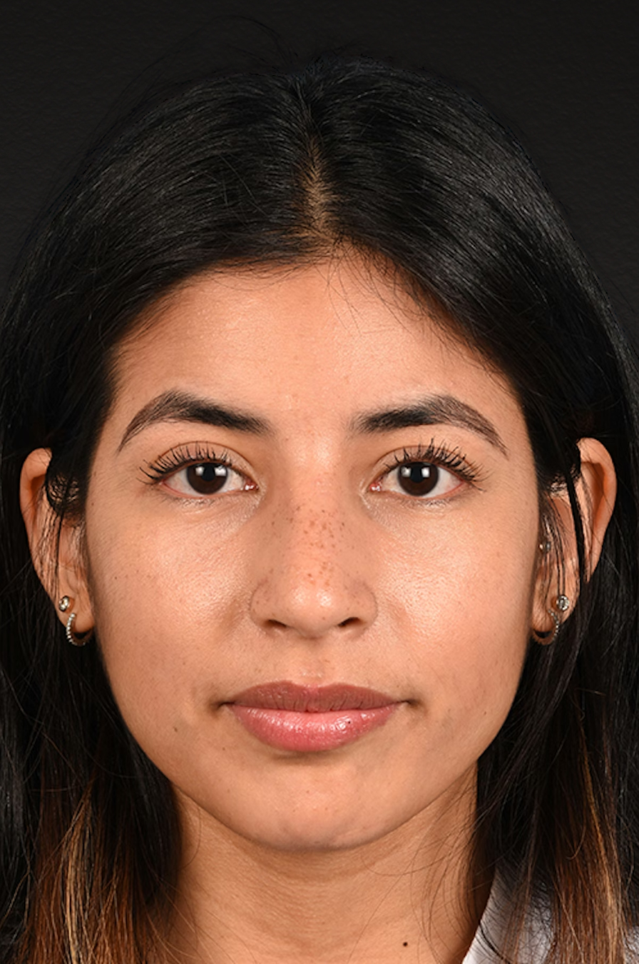 Rhinoplasty Before & After Gallery - Patient 428815 - Image 6
