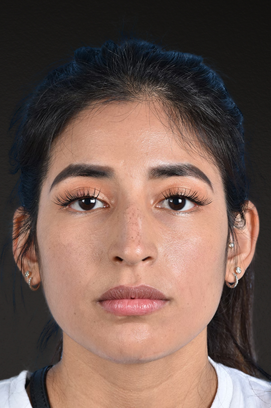 Rhinoplasty Before & After Gallery - Patient 428815 - Image 5