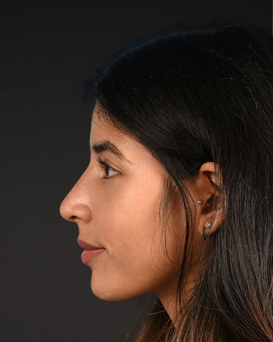 Rhinoplasty Before & After Gallery - Patient 428815 - Image 10