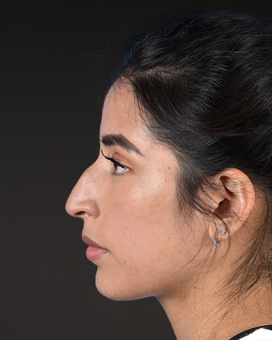 Rhinoplasty Before & After Gallery - Patient 428815 - Image 9