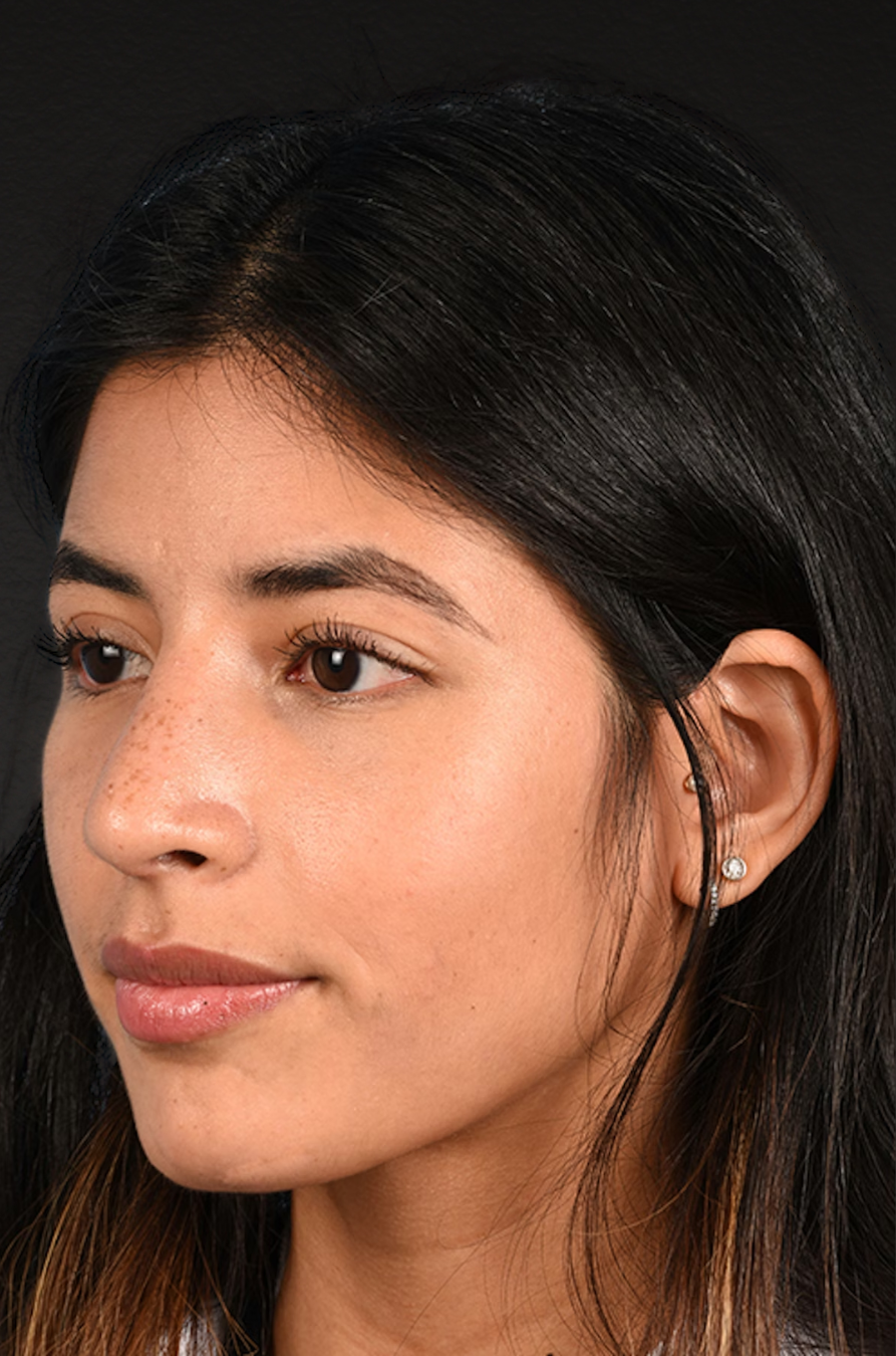 Rhinoplasty Before & After Gallery - Patient 428815 - Image 8