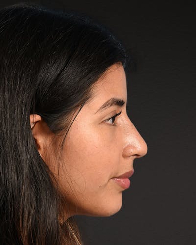 Rhinoplasty Before & After Gallery - Patient 428815 - Image 2