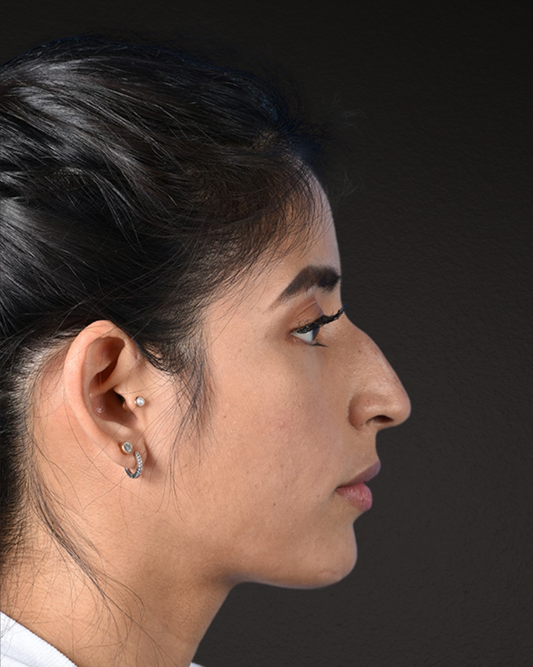 Rhinoplasty Before & After Gallery - Patient 428815 - Image 1