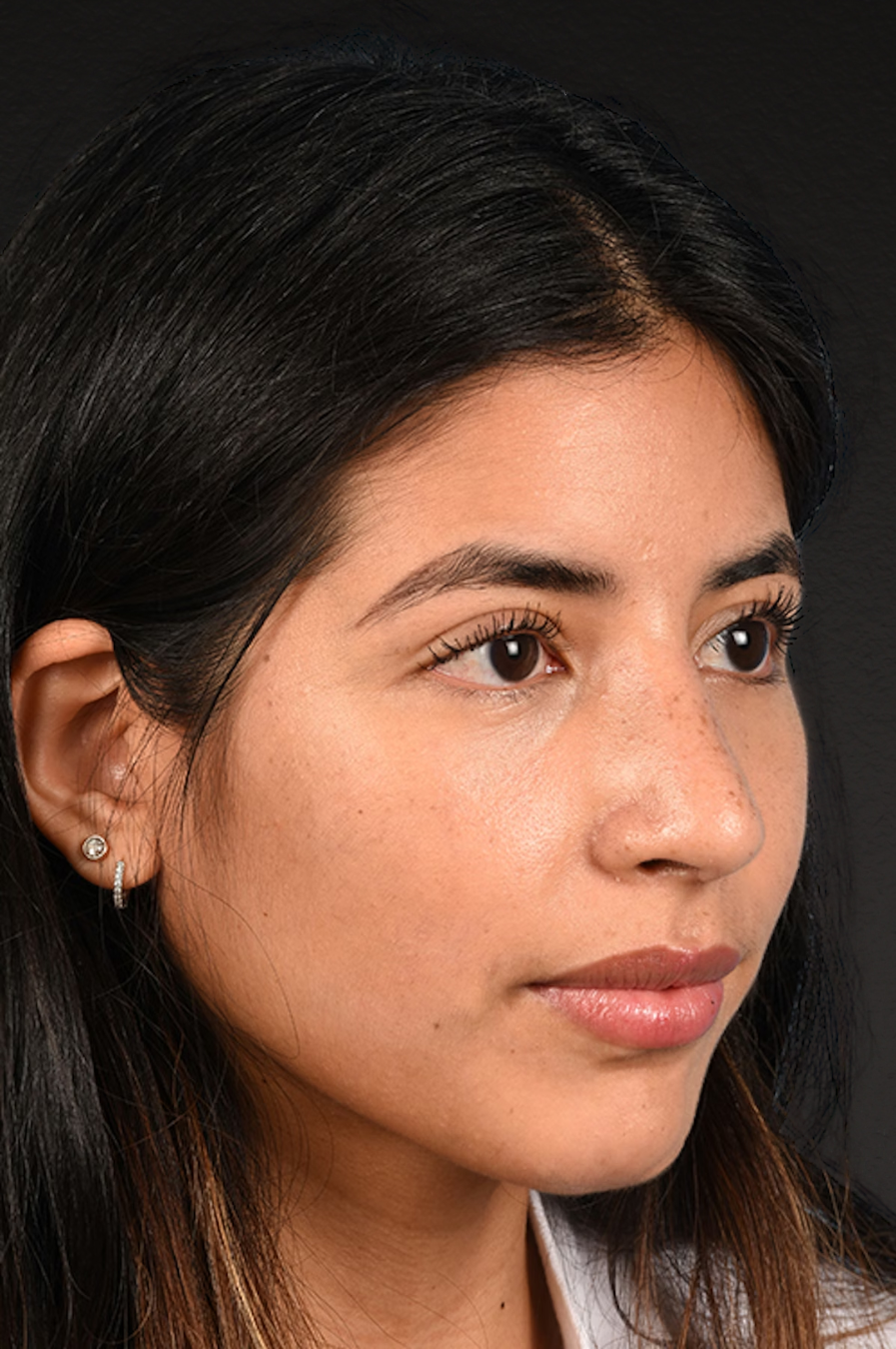 Rhinoplasty Before & After Gallery - Patient 428815 - Image 4