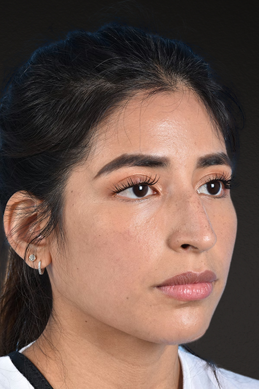 Rhinoplasty Before & After Gallery - Patient 428815 - Image 3
