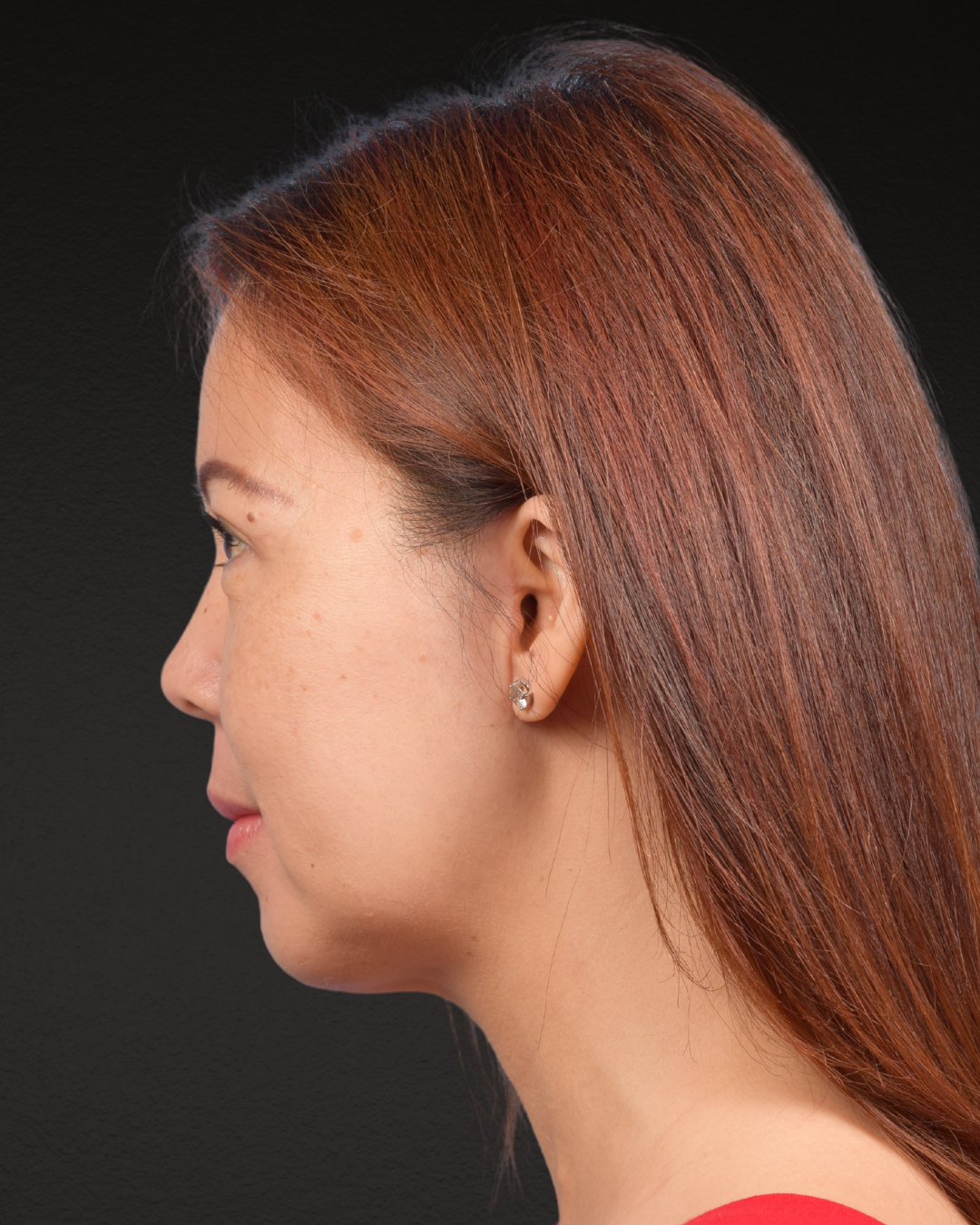 Facelift Before & After Gallery - Patient 384291 - Image 10