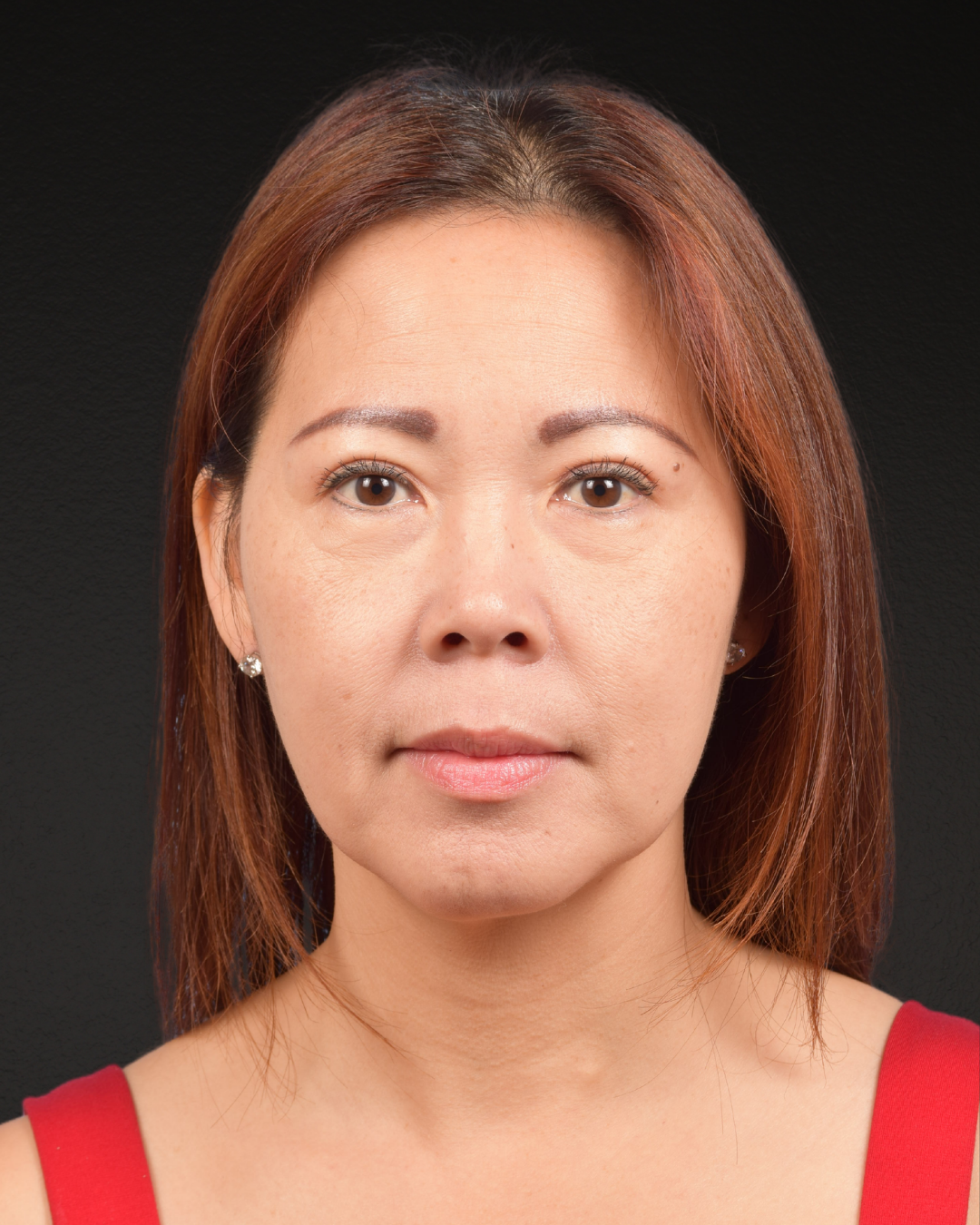 Facelift Before & After Gallery - Patient 384291 - Image 2