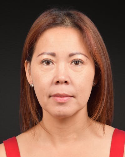 Facelift Before & After Gallery - Patient 384291 - Image 2