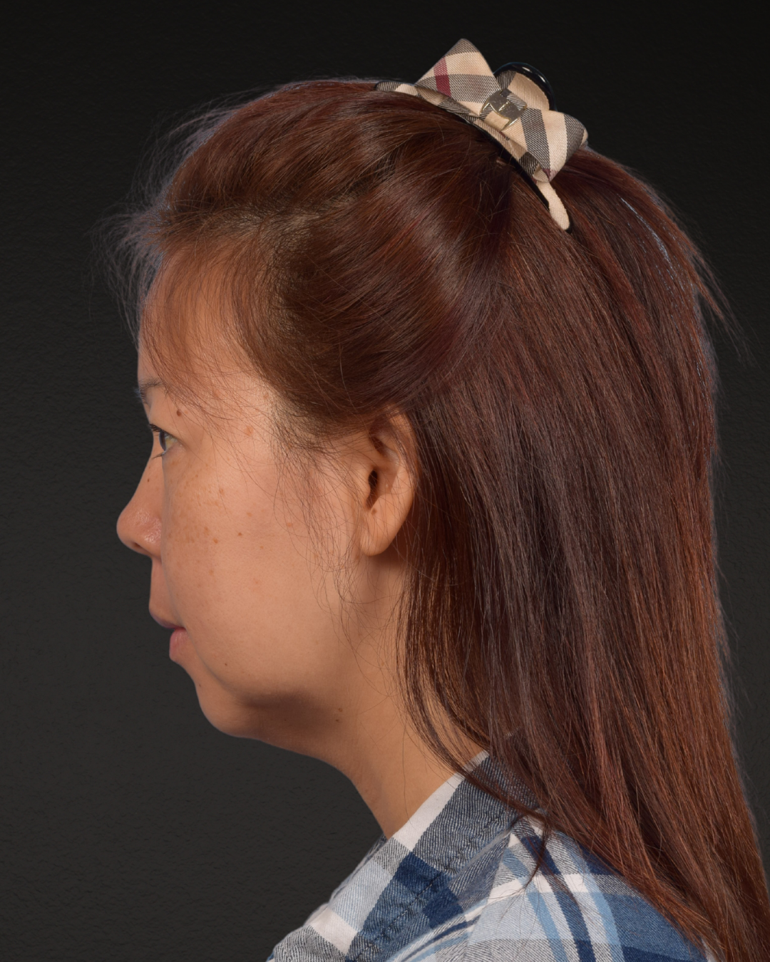 Facelift Before & After Gallery - Patient 384291 - Image 9