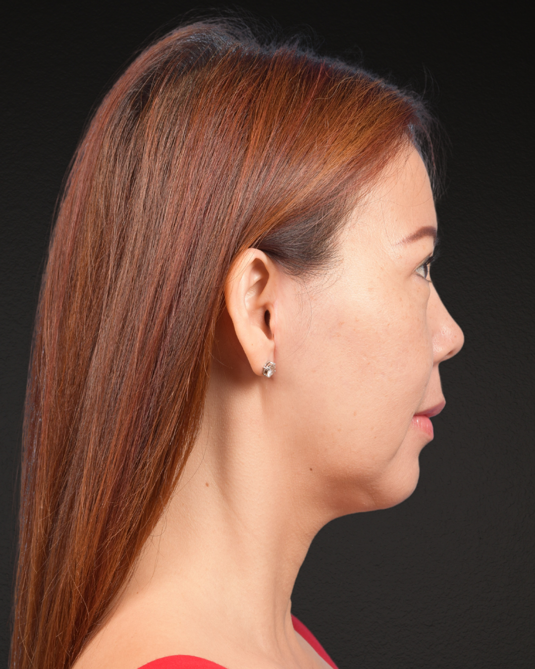 Facelift Before & After Gallery - Patient 384291 - Image 6