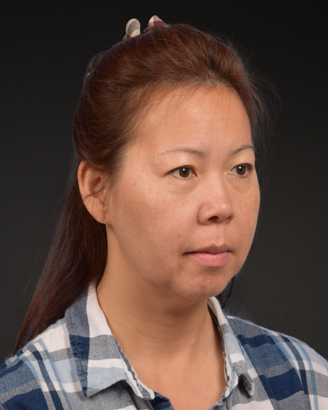Facelift Before & After Gallery - Patient 384291 - Image 3