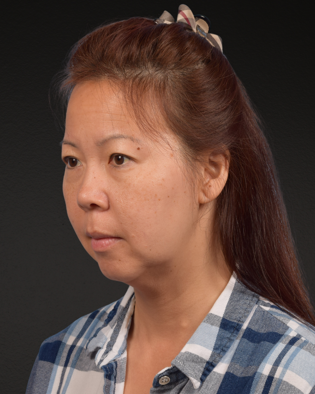 Facelift Before & After Gallery - Patient 384291 - Image 7