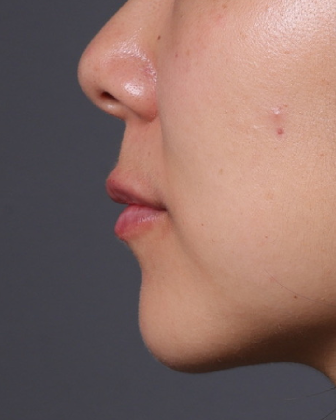Dermal Fillers Before & After Gallery - Patient 206577 - Image 6