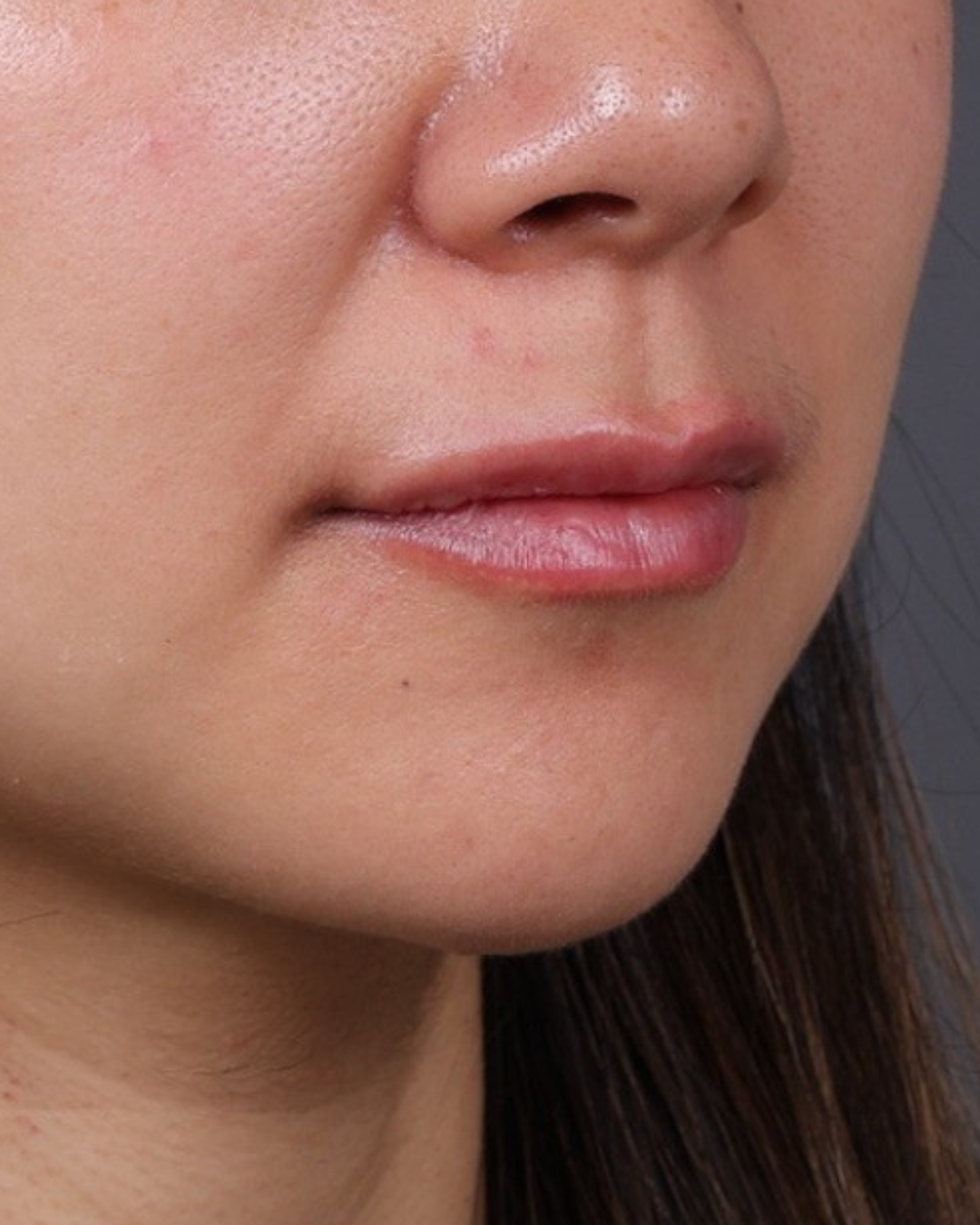 Dermal Fillers Before & After Gallery - Patient 206577 - Image 4