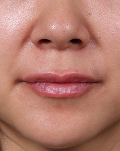 Dermal Fillers Before & After Gallery - Patient 206577 - Image 2