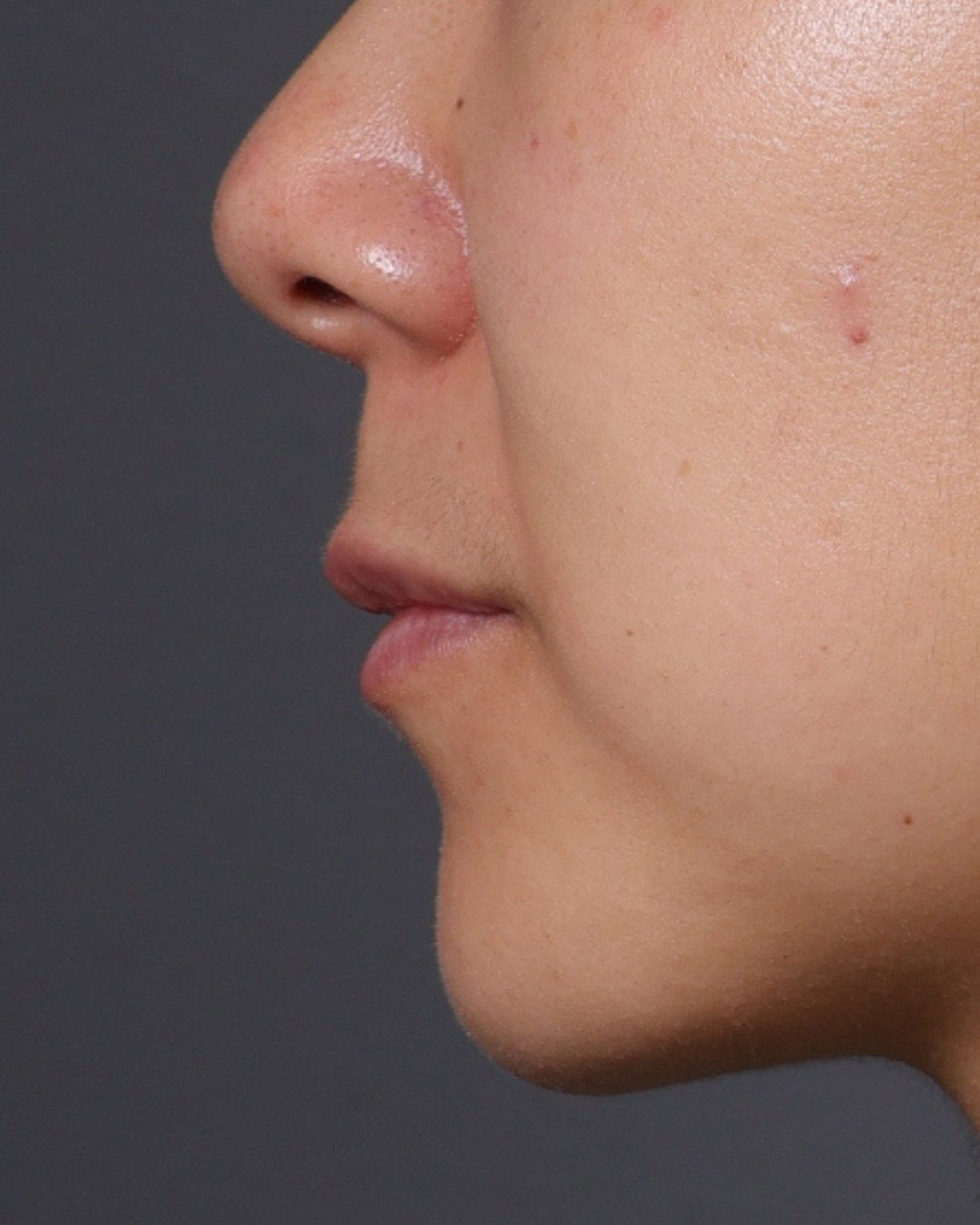Dermal Fillers Before & After Gallery - Patient 206577 - Image 5