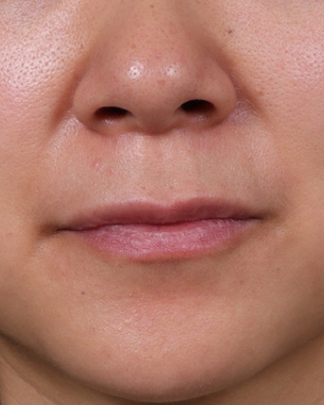 Dermal Fillers Before & After Gallery - Patient 206577 - Image 1