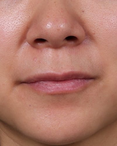 Dermal Fillers Before & After Gallery - Patient 206577 - Image 1