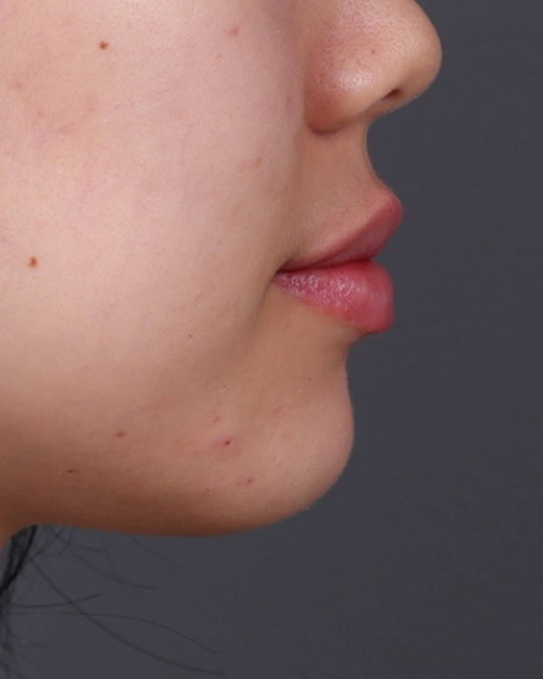 Dermal Fillers Before & After Gallery - Patient 377909 - Image 6