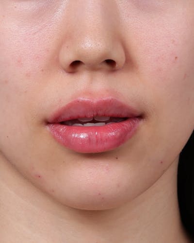 Dermal Fillers Before & After Gallery - Patient 377909 - Image 2