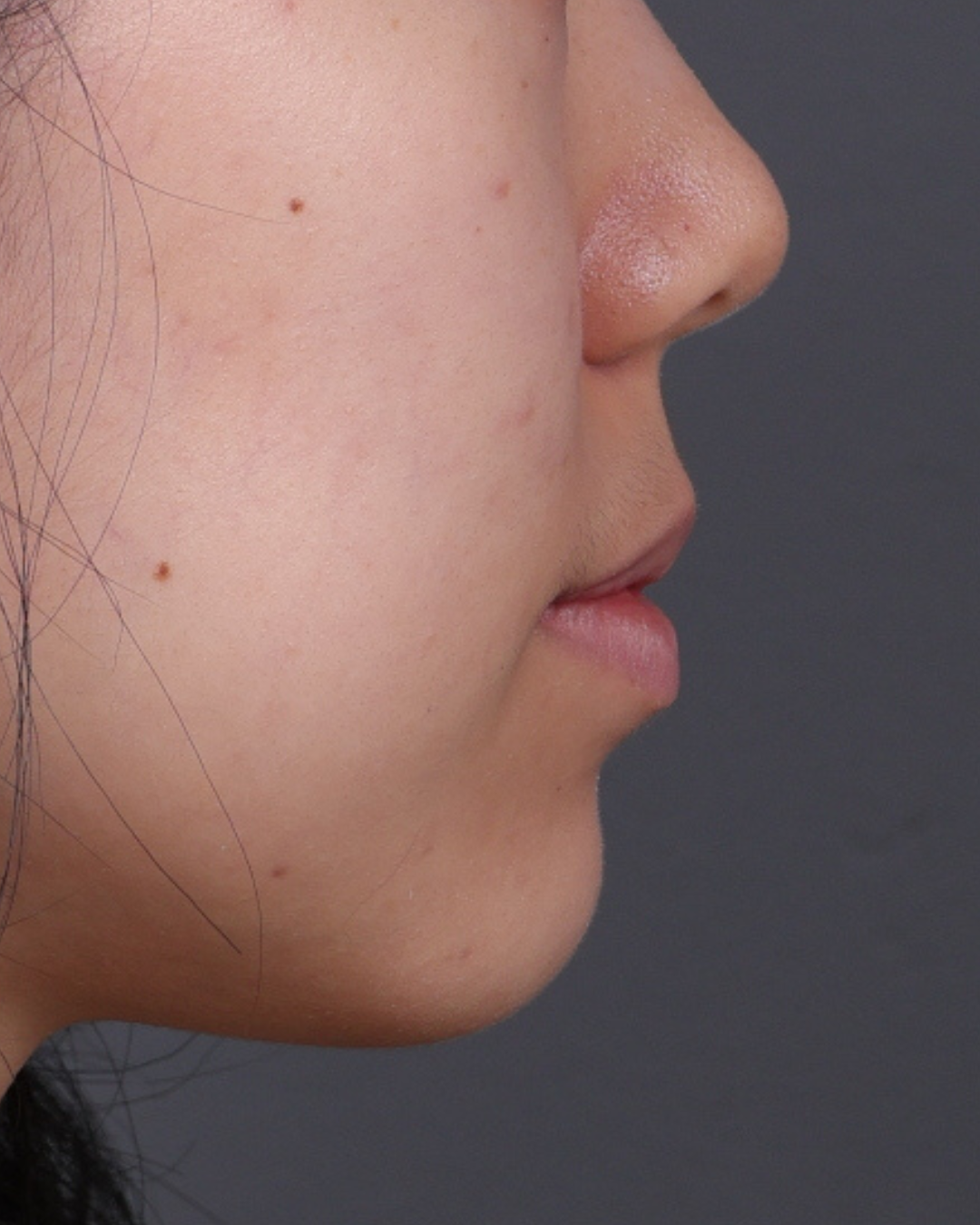 Dermal Fillers Before & After Gallery - Patient 377909 - Image 5