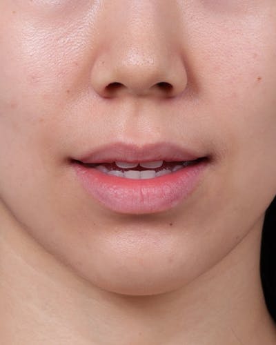Dermal Fillers Before & After Gallery - Patient 377909 - Image 1