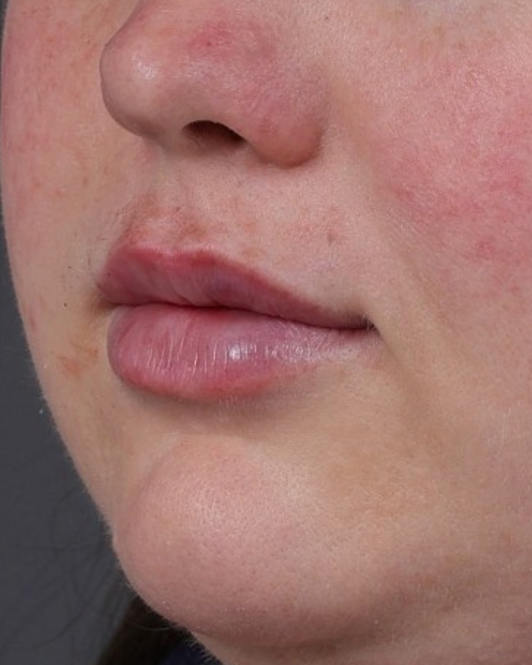 Dermal Fillers Before & After Gallery - Patient 296170 - Image 4