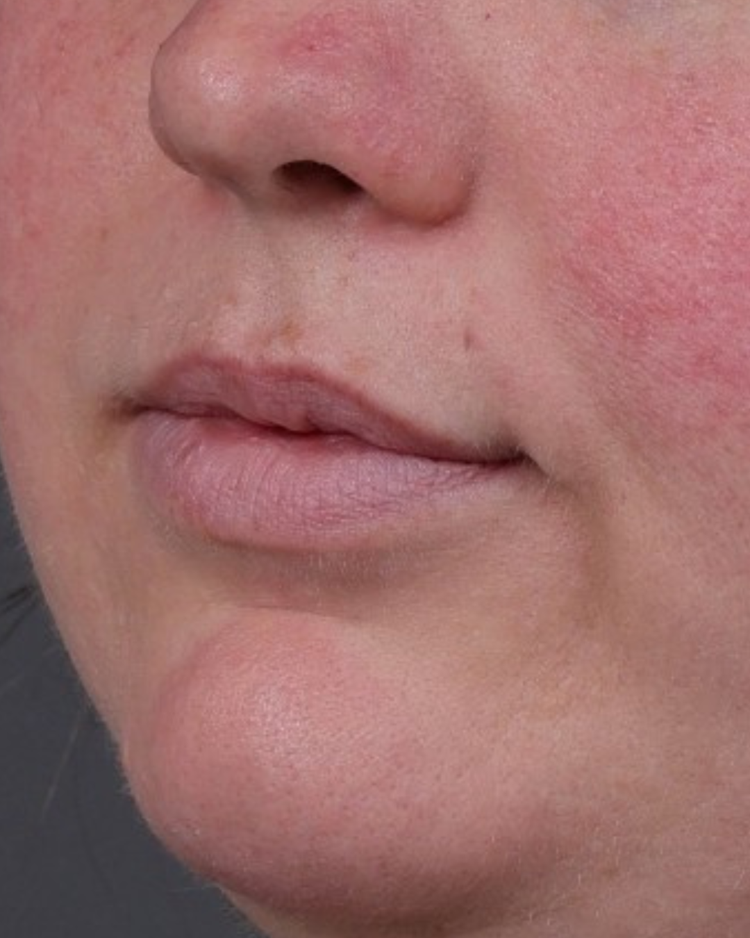 Dermal Fillers Before & After Gallery - Patient 296170 - Image 3