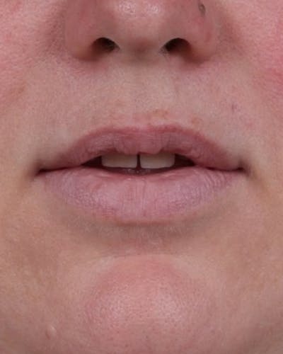 Dermal Fillers Before & After Gallery - Patient 296170 - Image 1