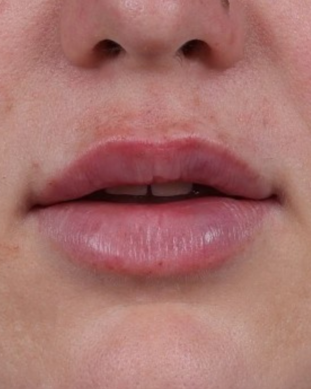 Dermal Fillers Before & After Gallery - Patient 296170 - Image 2