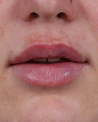 Dermal Fillers Before & After Gallery - Patient 296170 - Image 2