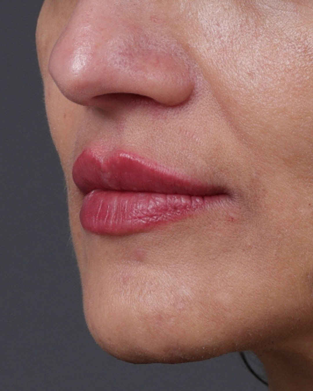 Dermal Fillers Before & After Gallery - Patient 119274 - Image 4