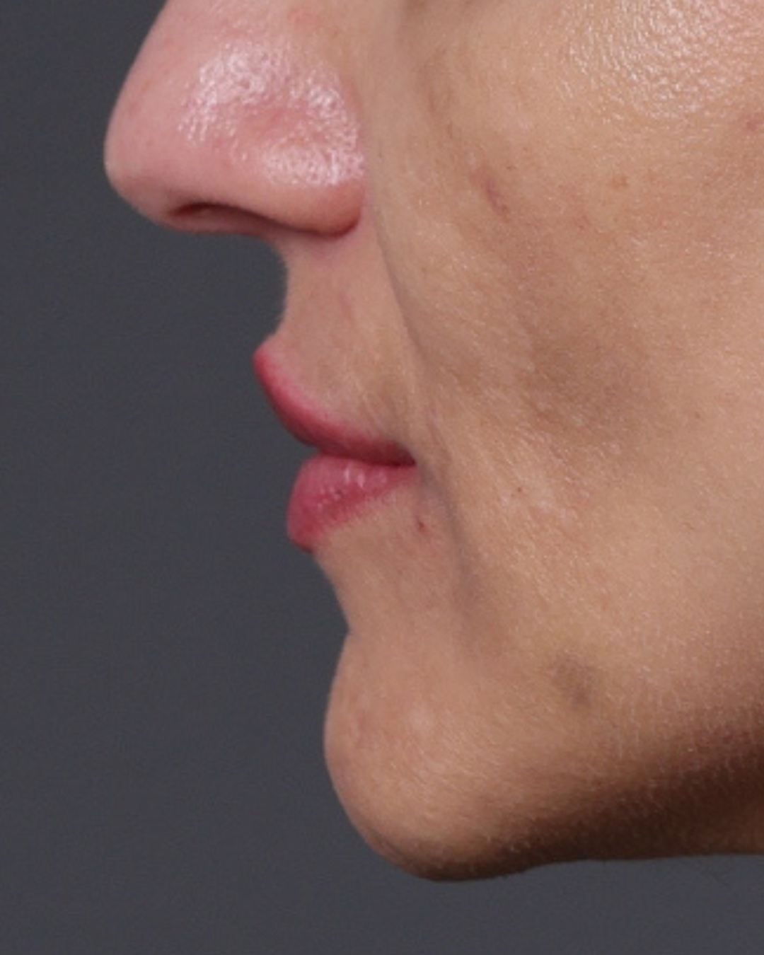 Dermal Fillers Before & After Gallery - Patient 119274 - Image 6