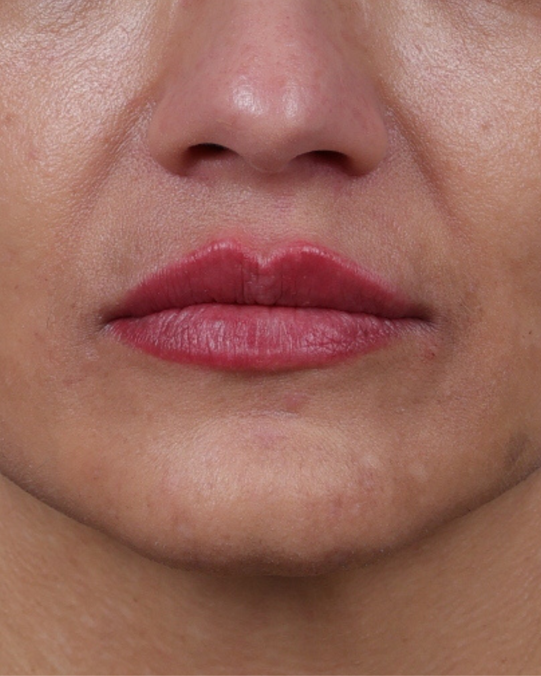 Dermal Fillers Before & After Gallery - Patient 119274 - Image 2