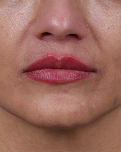 Dermal Fillers Before & After Gallery - Patient 119274 - Image 2