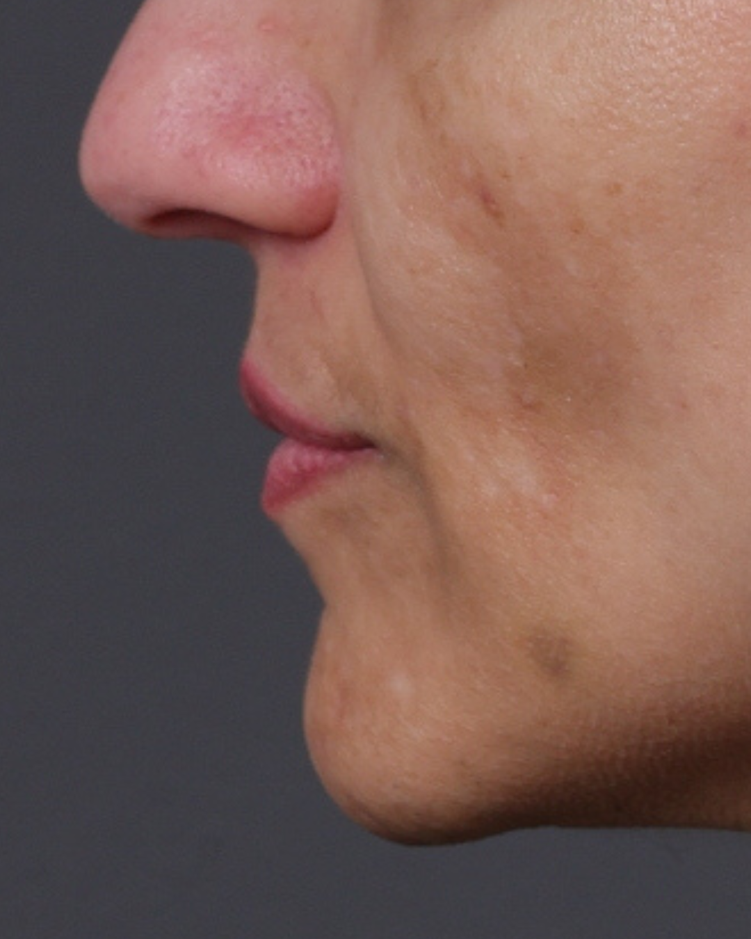 Dermal Fillers Before & After Gallery - Patient 119274 - Image 5