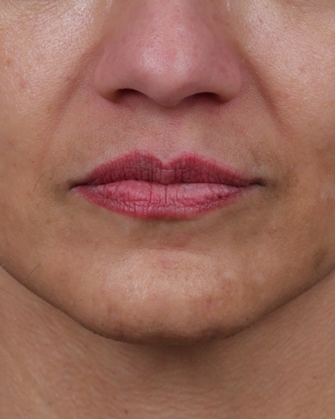 Dermal Fillers Before & After Gallery - Patient 119274 - Image 1