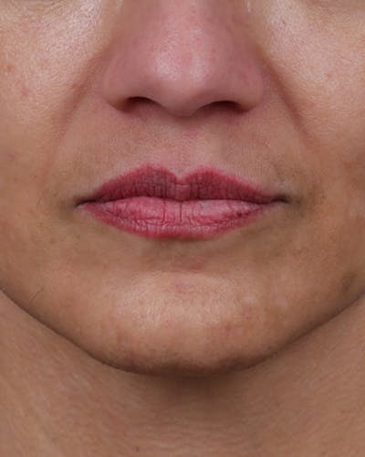 Dermal Fillers Before & After Gallery - Patient 119274 - Image 1
