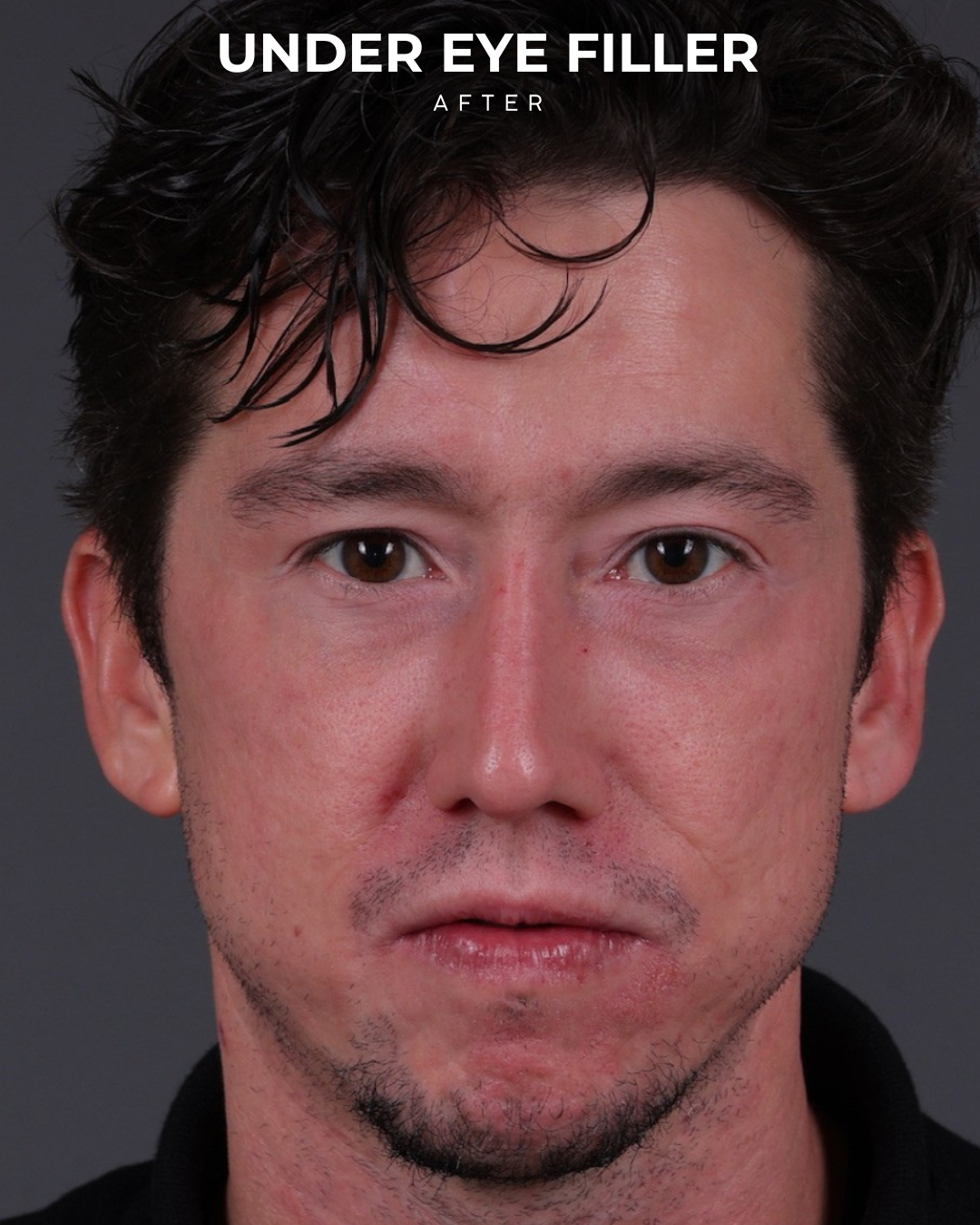 Dermal Fillers Before & After Gallery - Patient 934032 - Image 2