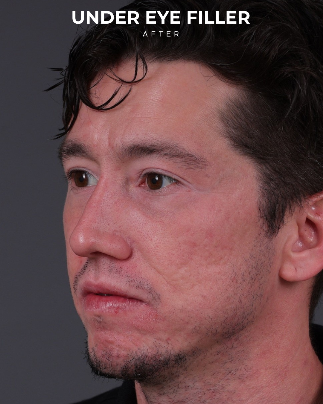 Dermal Fillers Before & After Gallery - Patient 934032 - Image 6