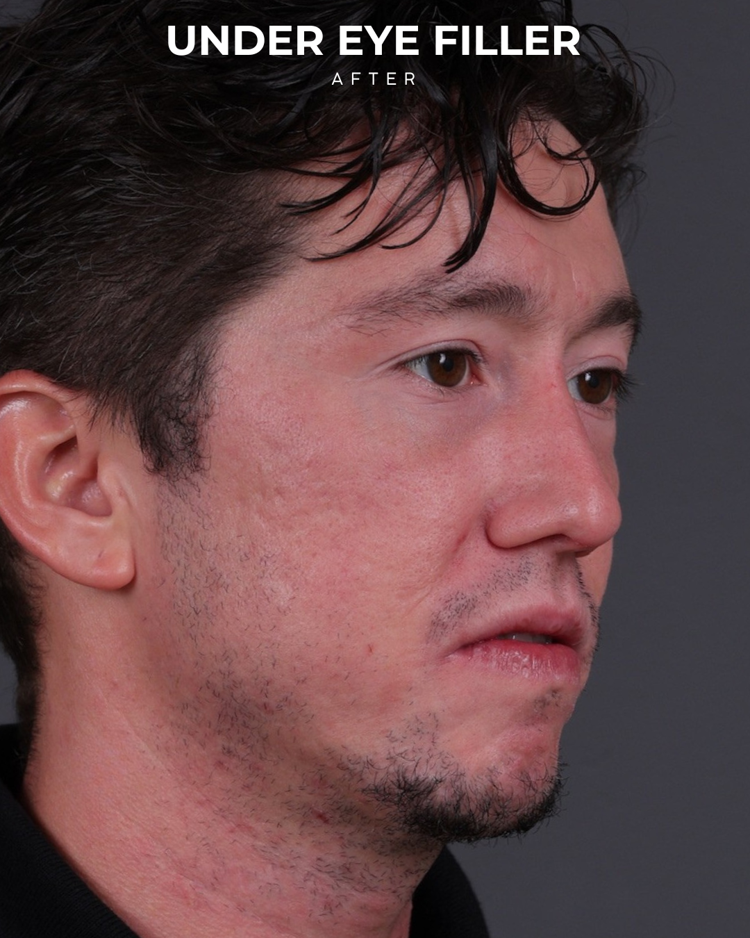 Dermal Fillers Before & After Gallery - Patient 934032 - Image 4