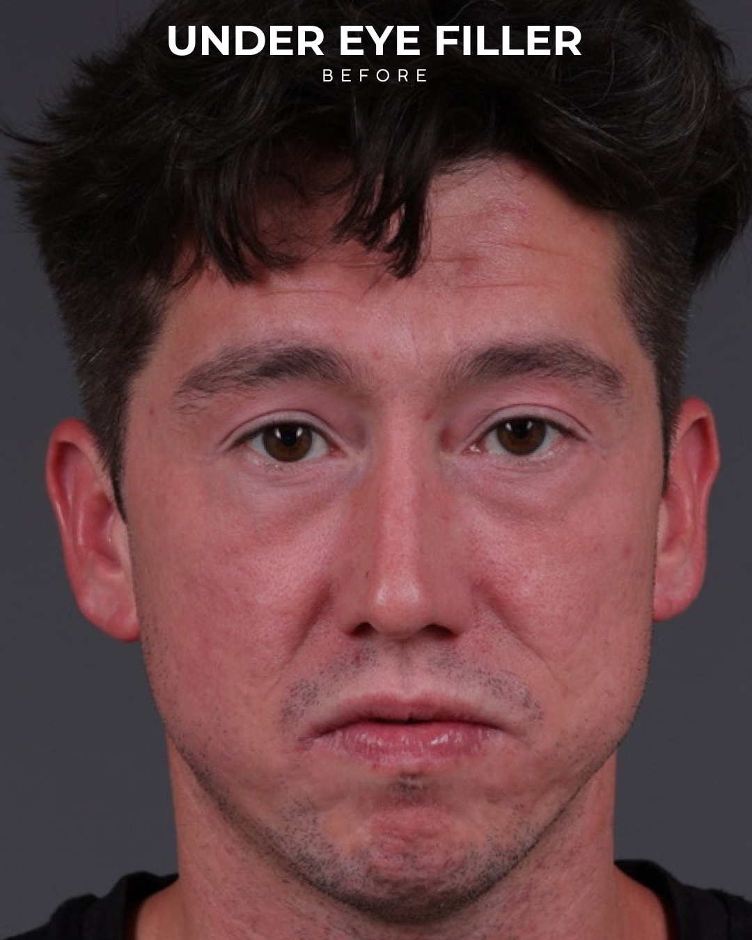 Dermal Fillers Before & After Gallery - Patient 934032 - Image 1