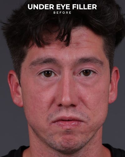 Dermal Fillers Before & After Gallery - Patient 934032 - Image 1