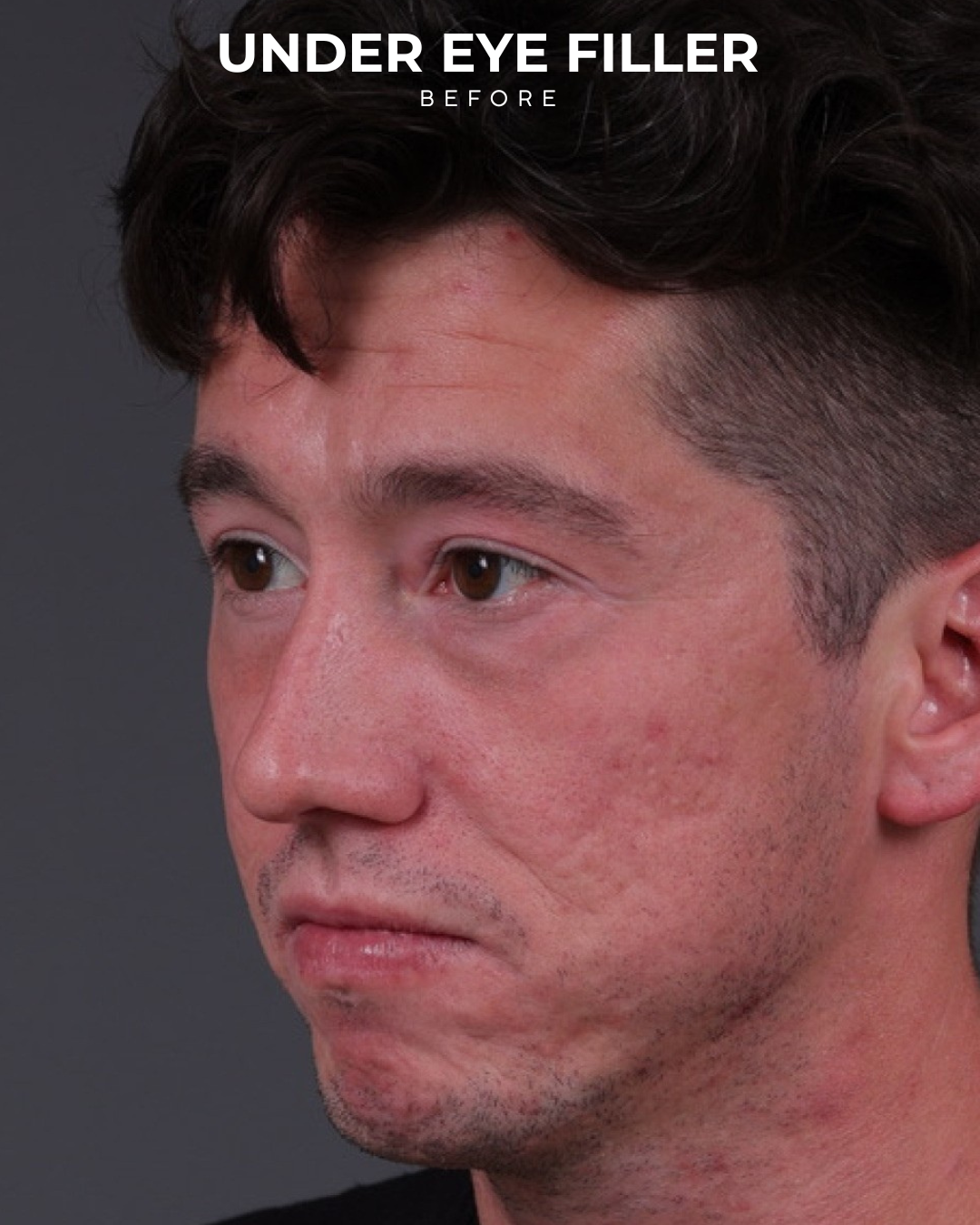 Dermal Fillers Before & After Gallery - Patient 934032 - Image 5