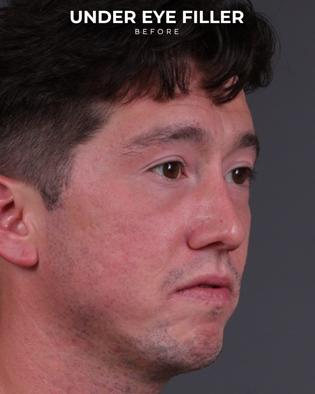 Dermal Fillers Before & After Gallery - Patient 934032 - Image 3