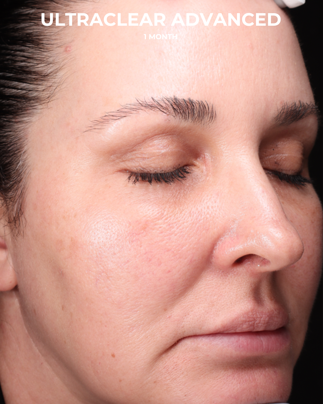 UltraClear Before & After Gallery - Patient 223793 - Image 4