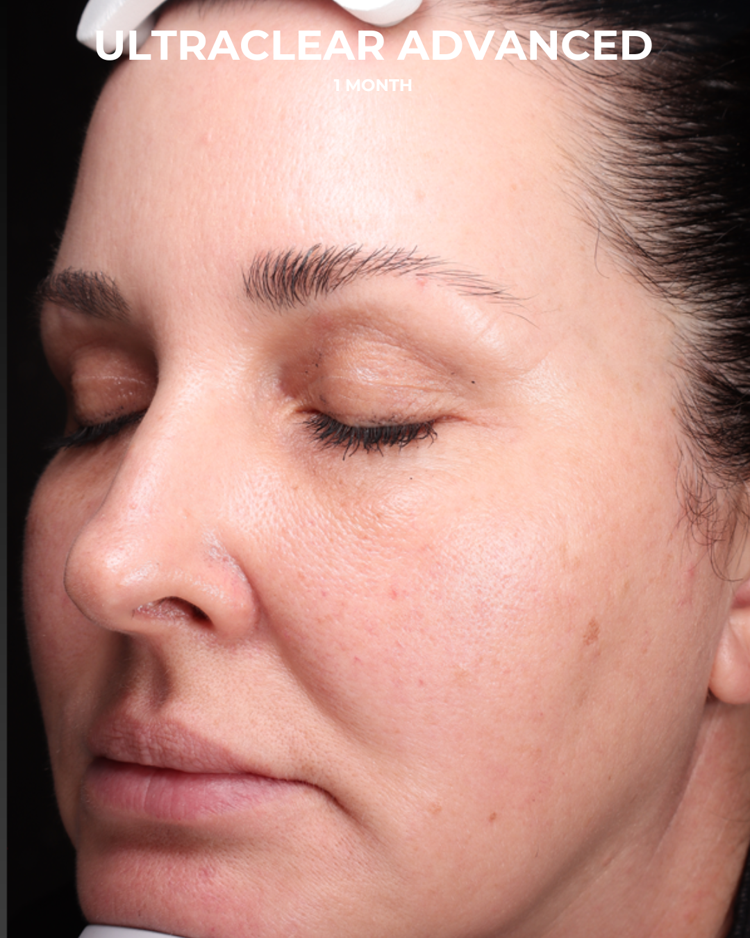 UltraClear Before & After Gallery - Patient 223793 - Image 6